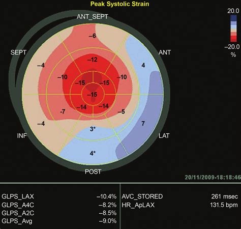 bullseye strain imaging